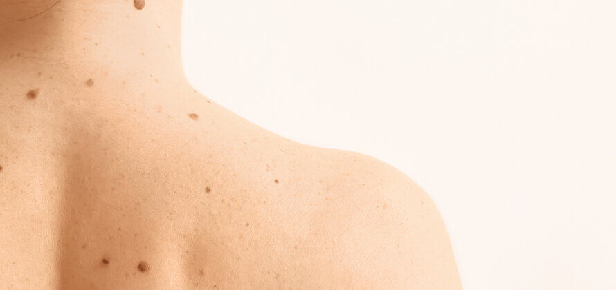 Din hud er kroppens vigtigste forsvar